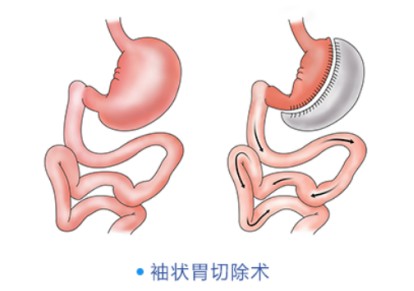 切胃减肥手术